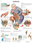 Arthritis - Anatomical Chart